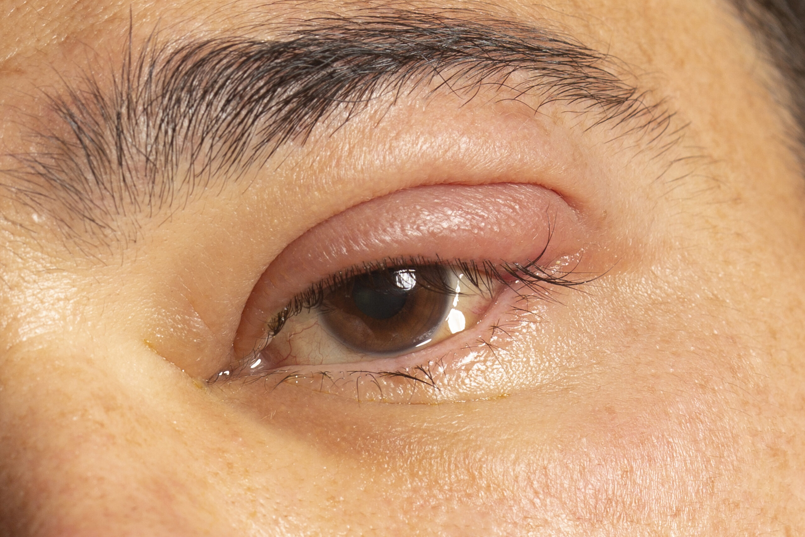 Read more about the article Dealing with Styes